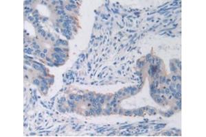 Detection of TFR in Human Rectum Cancer Tissue using Anti-Transferrin Receptor (TFR) Polyclonal Antibody (Transferrin Receptor 抗体  (AA 567-744))