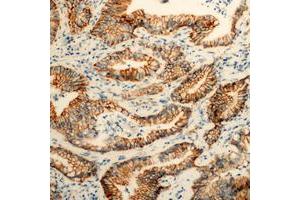 Immunohistochemical analysis of PEX11B staining in human colon cancer formalin fixed paraffin embedded tissue section. (PEX11B 抗体  (Center))