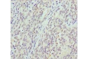 Immunohistochemistry of paraffin-embedded human lung cancer using ABIN7145471 at dilution of 1:100 (CRYGS 抗体  (AA 1-178))