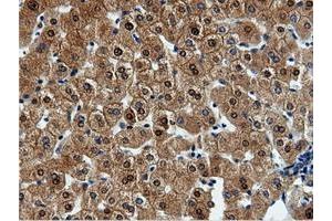 Immunohistochemical staining of paraffin-embedded Adenocarcinoma of Human endometrium tissue using anti-QPRT mouse monoclonal antibody. (QPRT 抗体)
