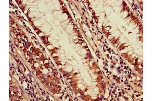 Immunohistochemistry of paraffin-embedded human colon cancer using ABIN7169756 at dilution of 1:100 (PDS5A 抗体  (AA 2-134))