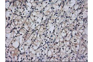 Immunohistochemical staining of paraffin-embedded Carcinoma of Human kidney tissue using anti-RASSF1 mouse monoclonal antibody. (RASSF1 抗体)