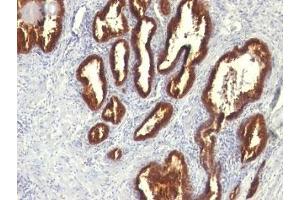 Formalin-fixed, paraffin-embedded human prostate carcinoma stained with Cytokeratin 18 antibody (KRT18/834).