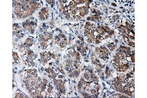 Immunohistochemical staining of paraffin-embedded Carcinoma of liver tissue using anti-LIPG mouse monoclonal antibody. (LIPG 抗体)