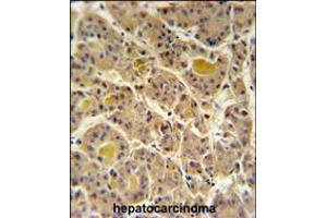 IN80D Antibody IHC analysis in formalin fixed and paraffin embedded human hepatocarcinoma followed by peroxidase conjugation of the secondary antibody and DAB staining. (IN80D 抗体  (N-Term))