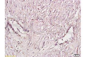 Formalin-fixed and paraffin embedded human cervical carcinoma labeled Anti-FGFR4 Polyclonal Antibody, Unconjugated (ABIN671766) at 1:200, followed by conjugation to the secondary antibody and DAB staining (FGFR4 抗体  (AA 1-100))