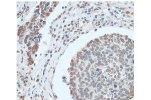 Immunohistochemistry of paraffin-embedded Human lung cancer using ZNF433 Polyclonal Antibody at dilution of 1:100 (40x lens). (ZNF433 抗体)