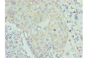 Immunohistochemistry of paraffin-embedded human lung cancer using ABIN7158582 at dilution of 1:100 (LUM 抗体  (AA 19-338))