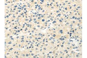 The image on the left is immunohistochemistry of paraffin-embedded Human liver cancer tissue using ABIN7193018(VIPR1 Antibody) at dilution 1/20, on the right is treated with synthetic peptide. (VIPR1 抗体)