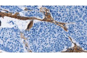 Immunohistochemistry of paraffin-embedded Human lung cancer tissue using COL3A1 Polyclonal Antibody at dilution 1:60 (COL3A1 抗体)