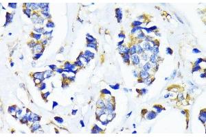 Immunohistochemistry of paraffin-embedded Human breast cancer using MRPL45 Polyclonal Antibody at dilution of 1:100 (40x lens). (MRPL45 抗体)