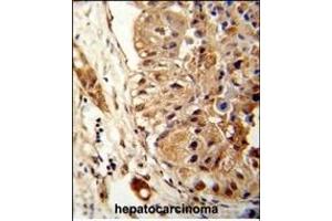 Formalin-fixed and paraffin-embedded human hepatocarcinoma reacted with ATLA2 Antibody (Center), which was peroxidase-conjugated to the secondary antibody, followed by DAB staining.
