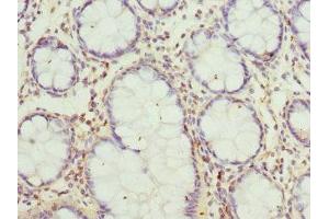 Immunohistochemistry of paraffin-embedded human colon cancer using ABIN7160702 at dilution of 1:100