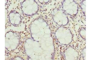 Immunohistochemistry of paraffin-embedded human colon cancer using ABIN7160702 at dilution of 1:100 (GCNT2 抗体  (AA 203-402))