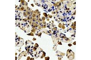 Immunohistochemical analysis of BCL2 (pT56) staining in human lung cancer formalin fixed paraffin embedded tissue section. (Bcl-2 抗体  (pSer56))