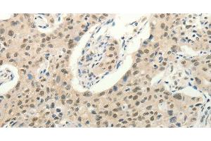 Immunohistochemistry of paraffin-embedded Human lung cancer tissue using Frizzled 10 Polyclonal Antibody at dilution 1:50 (FZD10 抗体)