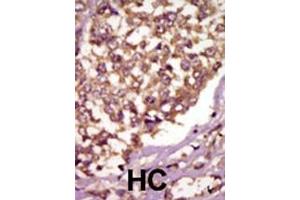 Formalin-fixed and paraffin-embedded human cancer tissue reacted with the primary antibody, which was peroxidase-conjugated to the secondary antibody, followed by AEC staining. (BMX 抗体  (AA 212-242))