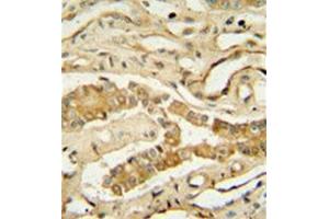 Immunohistochemistry analysis in formalin fixed and paraffin embedded human lung tissue reacted with NDUF3 Antibody (N-term) followed which was peroxidase conjugated to the secondary antibody and  followed by DAB staining. (NDUFAF3 抗体  (N-Term))