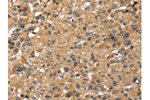 The image on the left is immunohistochemistry of paraffin-embedded Human liver cancer tissue using ABIN7191289(LONP1 Antibody) at dilution 1/25, on the right is treated with synthetic peptide. (LONP1 抗体)