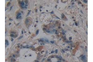 Detection of VIL in Human Pancreatic cancer Tissue using Polyclonal Antibody to Villin (VIL)