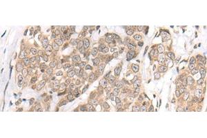 Immunohistochemistry of paraffin-embedded Human thyroid cancer tissue using M1AP Polyclonal Antibody at dilution of 1:80(x200) (Meiosis 1 Associated Protein (M1AP) 抗体)