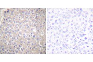 Peptide - +Immunohistochemical analysis of paraffin-embedded human breast carcinoma tissue using E-cadherin antibody. (E-cadherin 抗体)