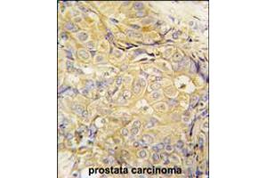 Formalin-fixed and paraffin-embedded human prostata carcinoma tissue reacted with FGF10 antibody , which was peroxidase-conjugated to the secondary antibody, followed by DAB staining. (FGF10 抗体  (C-Term))