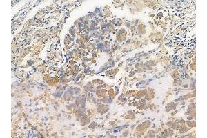 ABIN6258478 and ABIN6276099 at 1/100 staining human lung adenocarcinoma by IHC-P.