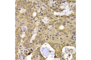 Immunohistochemistry of paraffin-embedded human oophoroma using NAA20 antibody. (NAT5 抗体  (AA 49-178))