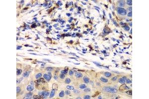 Immunohistochemistry of paraffin-embedded Human esophageal cancer using S100A8 Polyclonal Antibody at dilution of 1:100 (40x lens). (S100A8 抗体)