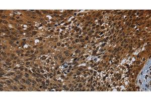 Immunohistochemistry of paraffin-embedded Human cervical cancer tissue using KDM4B Polyclonal Antibody at dilution 1:50 (KDM4B 抗体)