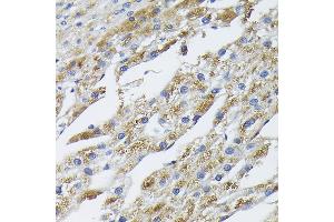 Immunohistochemistry of paraffin-embedded human liver cancer using BMP2 Rabbit pAb (ABIN3020733, ABIN3020734, ABIN1512642, ABIN1513827 and ABIN6213697) at dilution of 1:100 (40x lens). (BMP2 抗体  (AA 283-396))