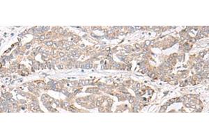 Immunohistochemistry of paraffin-embedded Human liver cancer tissue using CHST4 Polyclonal Antibody at dilution of 1:35(x200) (CHST4 抗体)