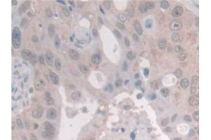 Detection of NCOA3 in Human Breast cancer Tissue using Polyclonal Antibody to Nuclear Receptor Coactivator 3 (NCOA3) (NCOA3 抗体  (AA 1023-1304))