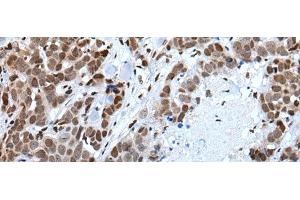 Immunohistochemistry of paraffin-embedded Human thyroid cancer tissue using CELF5 Polyclonal Antibody at dilution of 1:65(x200) (CELF5 抗体)