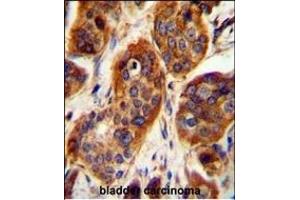 LRRC57 Antibody (C-term) (ABIN654494 and ABIN2844226) immunohistochemistry analysis in formalin fixed and paraffin embedded human bladder carcinoma followed by peroxidase conjugation of the secondary antibody and DAB staining. (LRRC57 抗体  (C-Term))