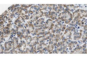 ABIN6274573 at 1/100 staining Human liver cancer tissue by IHC-P. (HTR2C 抗体  (Internal Region))