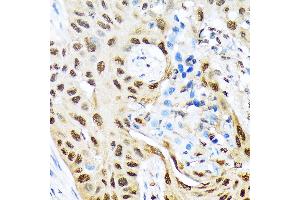 Immunohistochemistry of paraffin-embedded human lung cancer using HES5 Rabbit mAb (ABIN7267559) at dilution of 1:100 (40x lens). (HES5 抗体)