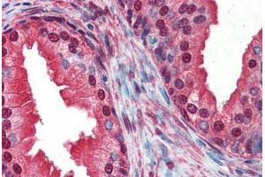 Human Prostate (formalin-fixed, paraffin-embedded) stained with COPS5 antibody ABIN337275 at 10 ug/ml followed by biotinylated anti-mouse IgG secondary antibody ABIN481714, alkaline phosphatase-streptavidin and chromogen. (COPS5 抗体  (Internal Region))