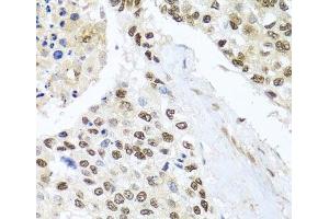 Immunohistochemistry of paraffin-embedded Human lung cancer using BNIP3L Polyclonal Antibody at dilution of 1:100 (40x lens). (BNIP3L/NIX 抗体)