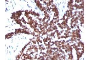 Formalin-fixed, paraffin-embedded human ovarian carcinoma stained with Cyclin B1 antibody.
