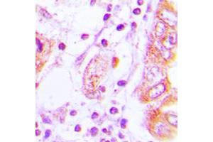 Immunohistochemical analysis of iNOS staining in human lung cancer formalin fixed paraffin embedded tissue section. (NOS2 抗体  (C-Term))