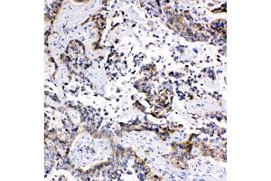 Anti-MRP1 antibody, IHC(P) IHC(P): Human Lung Cancer Tissue