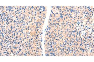 Immunohistochemistry of paraffin-embedded Human liver cancer using PAFAH2 Polyclonal Antibody at dilution of 1:80 (PAFAH2 抗体)