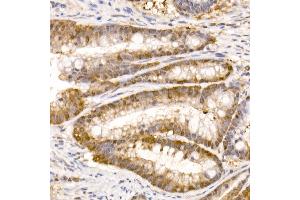 Immunohistochemistry of paraffin-embedded human colon carcinoma using Bag1 Rabbit mAb (ABIN7265847) at dilution of 1:50 (40x lens). (BAG1 抗体)