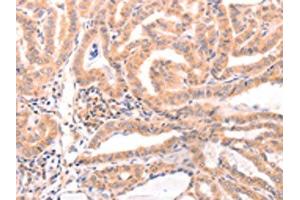 The image on the left is immunohistochemistry of paraffin-embedded Human thyroid cancer tissue using ABIN7129152(DAZ4 Antibody) at dilution 1/50, on the right is treated with fusion protein. (DAZ4 抗体)