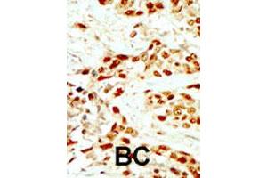 Formalin-fixed and paraffin-embedded human cancer tissue reacted with DAPK2 polyclonal antibody  , which was peroxidase-conjugated to the secondary antibody, followed by DAB staining.