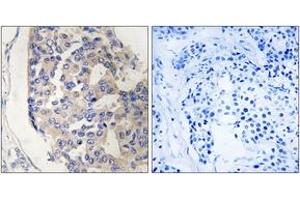 Immunohistochemistry analysis of paraffin-embedded human breast carcinoma tissue, using C1S Antibody. (C1S 抗体  (AA 541-590))