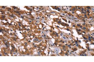 Immunohistochemistry of paraffin-embedded Human thyroid cancer tissue using GREB1 Polyclonal Antibody at dilution 1:40 (GREB1 抗体)