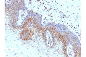 Formalin-fixed, paraffin-embedded human Cervical Carcinoma stained with Beta-2-Microglobulin Monoclonal Antibody (SPM617) (beta-2 Microglobulin 抗体)